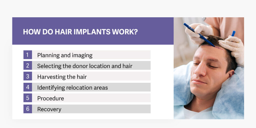 steps to a hair transplant