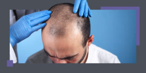 pros and cons of hair transplant surgery