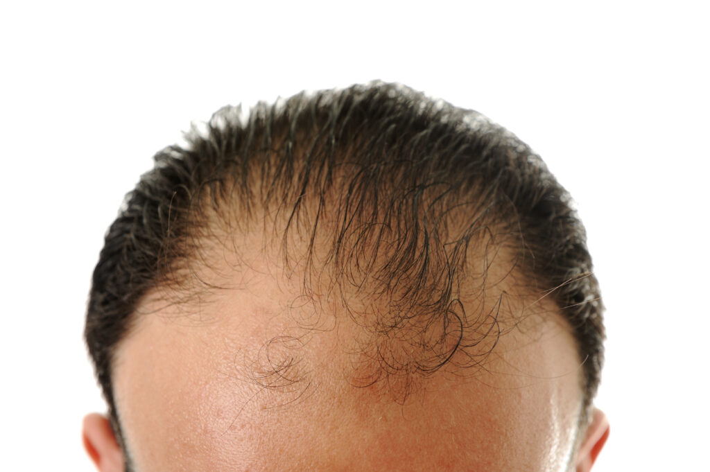 Hair loss