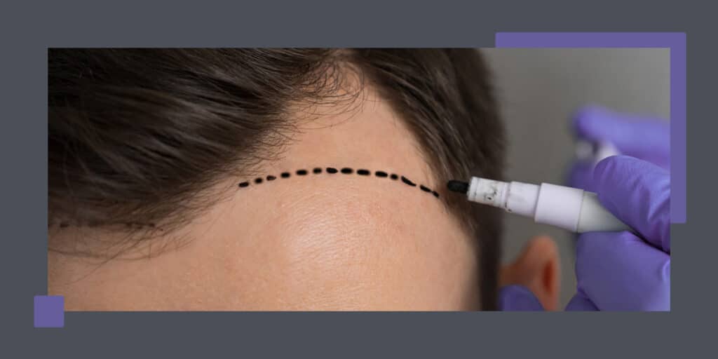 correct-bad-hair-translplant-1024x512